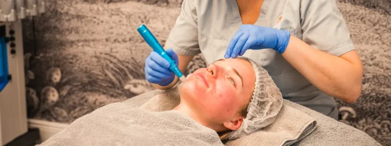 microneedling-v1-x1920.png